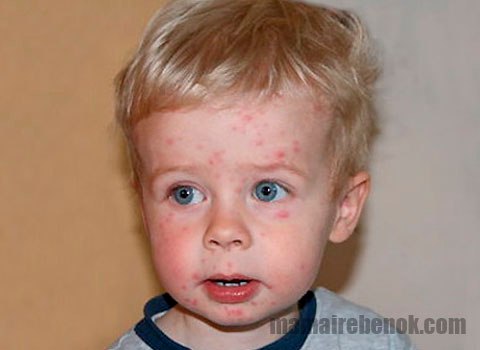Краснухой заболевают преимущественно дети в возрасте